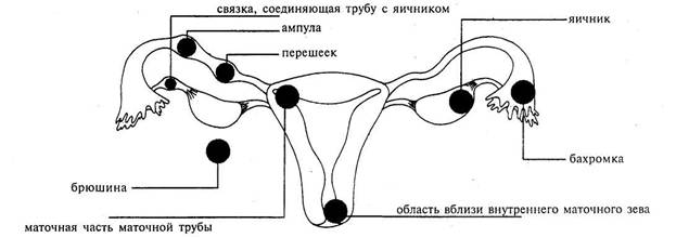 Внематочная беременность картинки для презентации